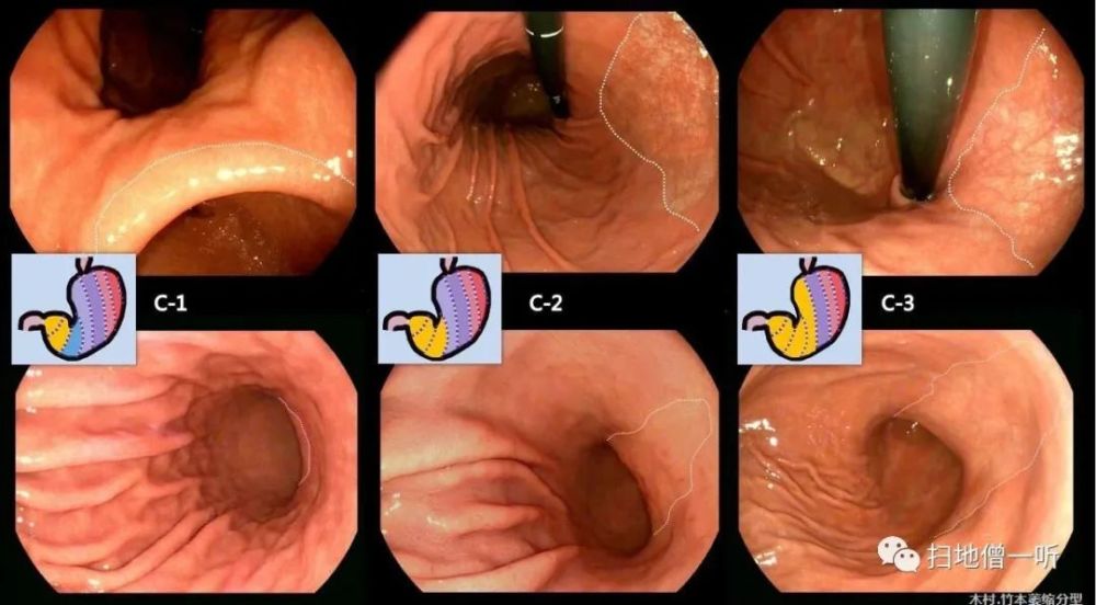医学美图:标准胃镜检查m路径法