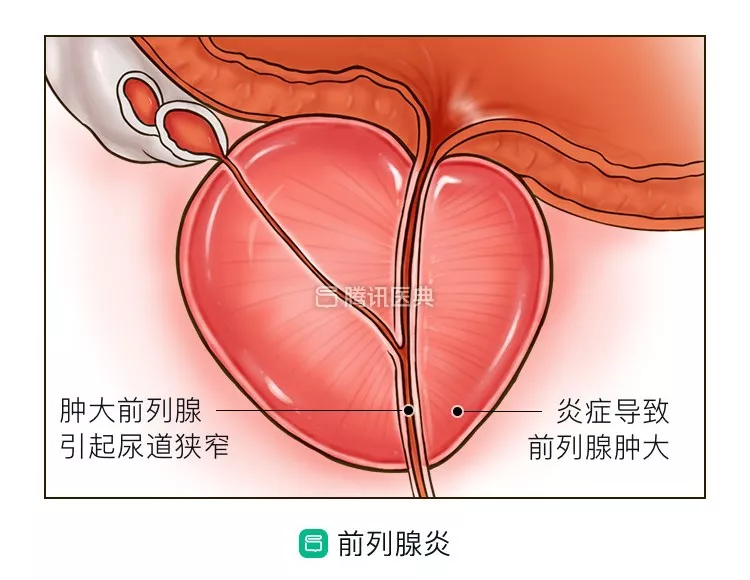 一文说清你最关心的6个前列腺问题!男性一定要看