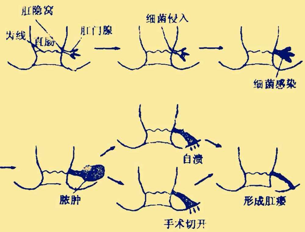 得了肛瘘太痛苦医生告诉您这样做就能更好地预防