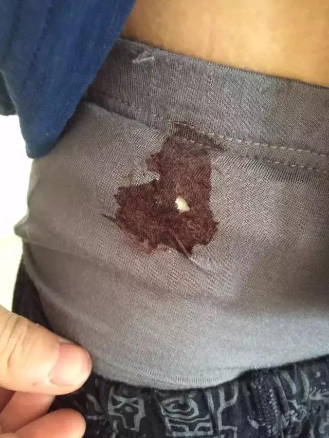 绍兴一家人吃饭被打伤 孕妇肚子被踩