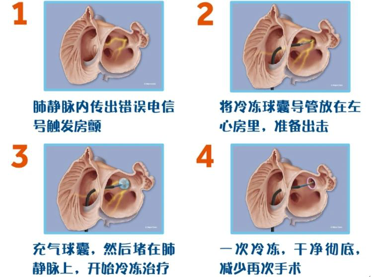 房颤治疗新手段冷冻球囊消融术