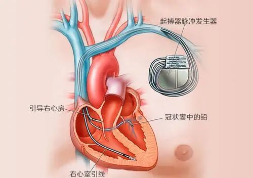 太阳能"无线"充电心脏起搏器 韩国研发新型医疗器械充电材料