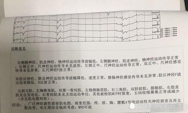 是患者于2018年6月在当地医院做的2次肌电图,均提示神经源性损害;第1