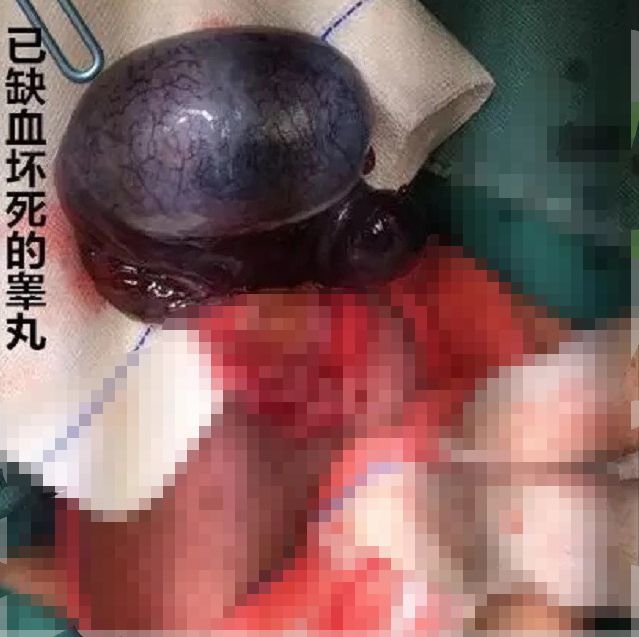 【后悔】17岁大男孩的"小鸡鸡",像两三岁孩子……这件