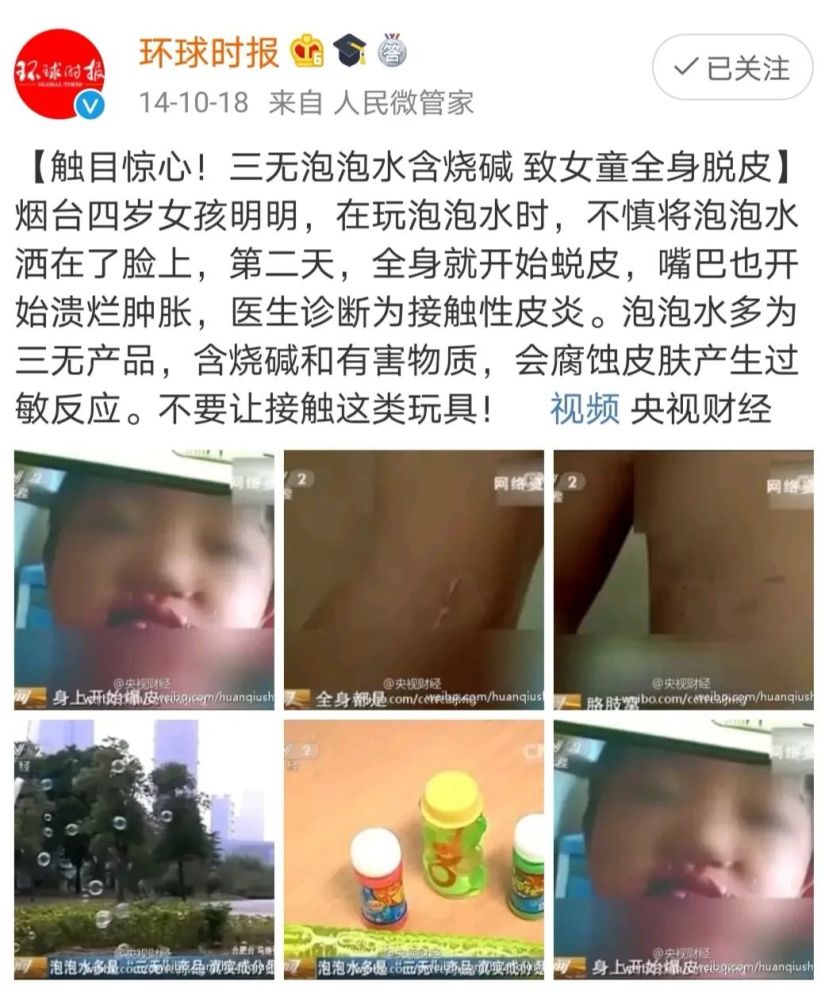 4岁的小女孩不小心将泡泡水洒在了脸上,结果导致皮肤蜕皮,溃烂肿胀