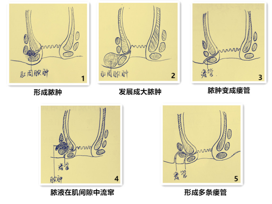 "菊"部地区脓肿大如鸡蛋,这种痛你忍or不忍?