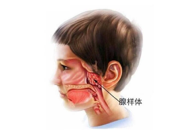 重庆中民耳鼻喉医院:小孩腺样体肥大怎么回事,怎么