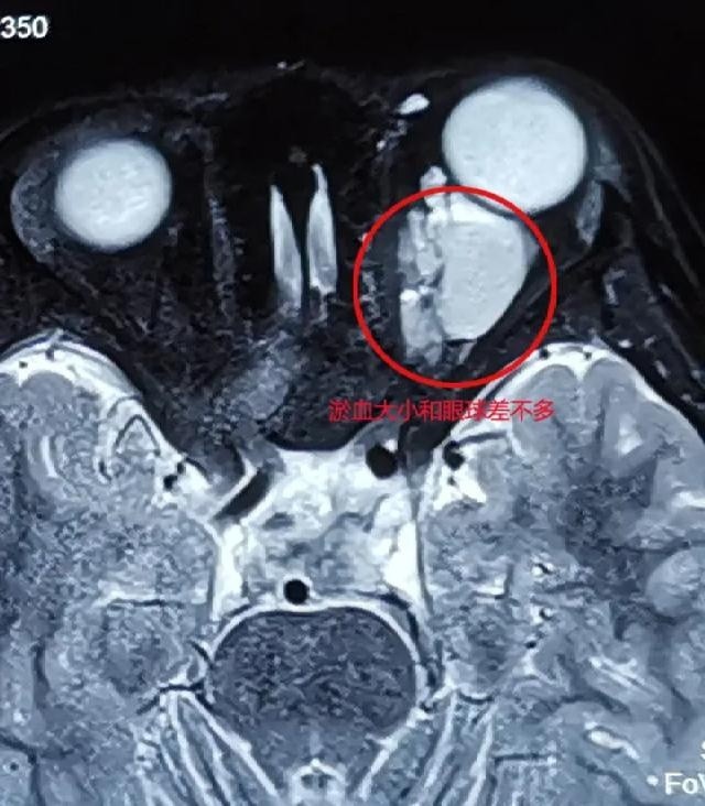 眼球突出来又能装回去？浙江6岁男孩好奇模仿短视频特效，出事了