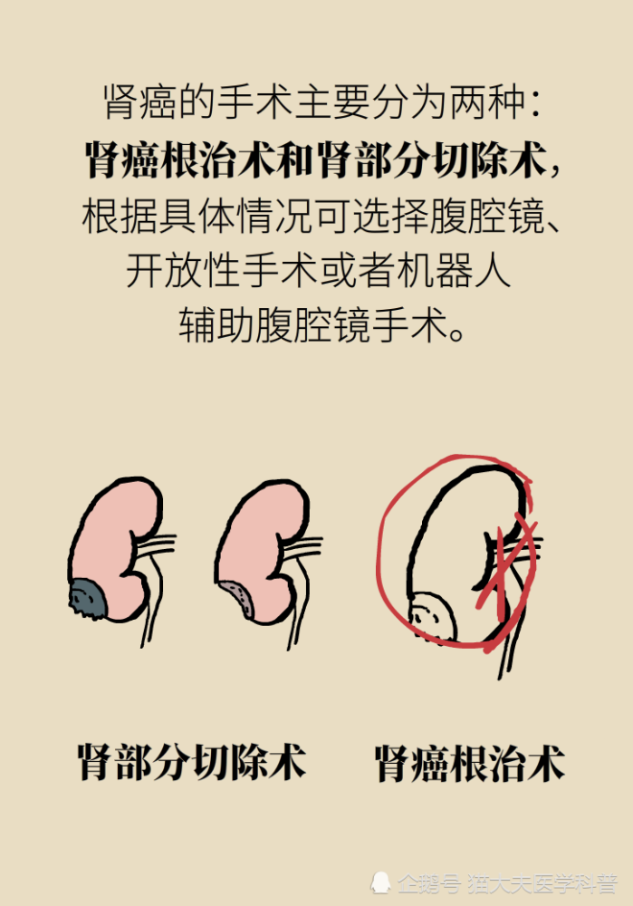 关于长在“腰子”上的癌，带你一文了解肾癌这名“沉默杀手”