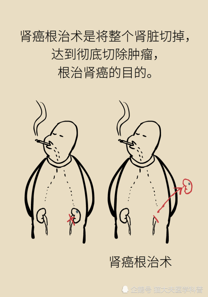 关于长在“腰子”上的癌，带你一文了解肾癌这名“沉默杀手”