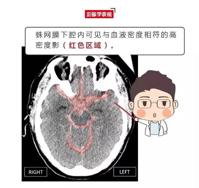 急诊入院,走着出院,自发性蛛网膜下腔出血是怎么好转的