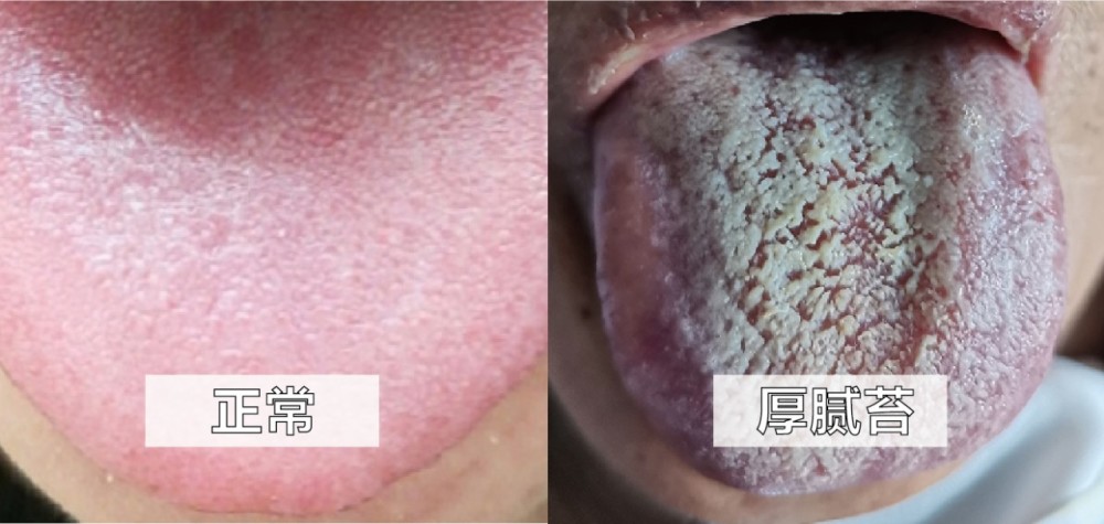 阳虚体质:舌质淡 易患:胰腺癌,肠癌,鼻咽癌,肾癌,宫颈癌等 血瘀体质