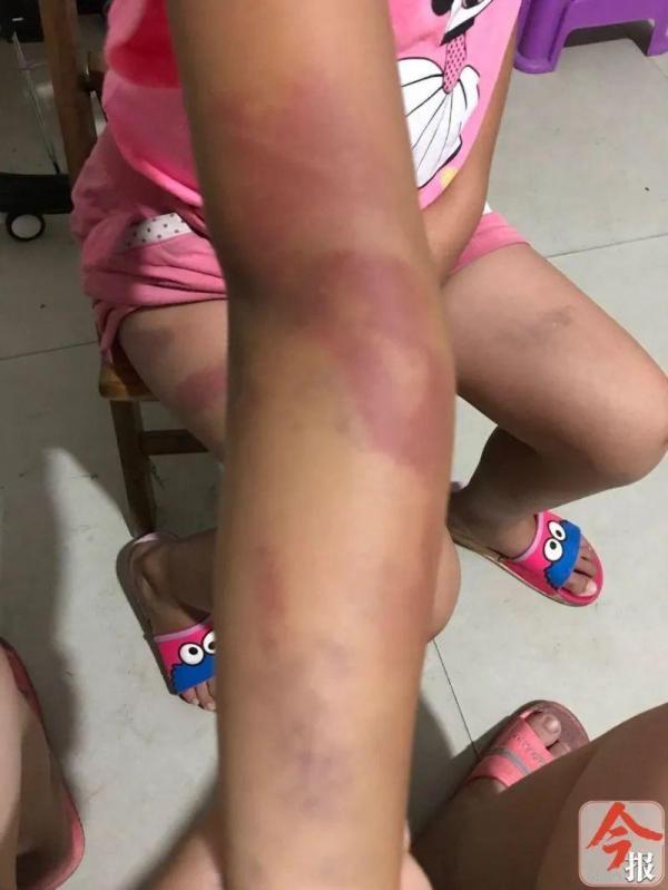 柳州一小学女生身上多处淤青,家长称遭老师殴打!校方:警方已介入