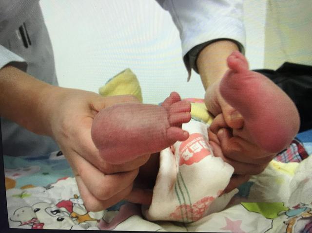 孩子出生才发现有足内翻缺陷，父母该怎么办？