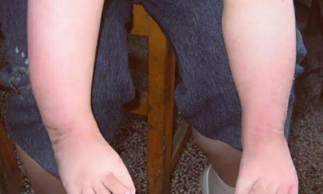 孩子出生才发现有足内翻缺陷，父母该怎么办？