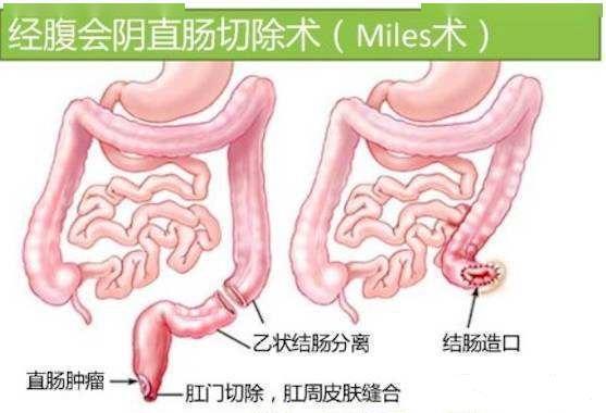 医生要挖掉我的肛门,以后还怎么排便?宁死也不做手术