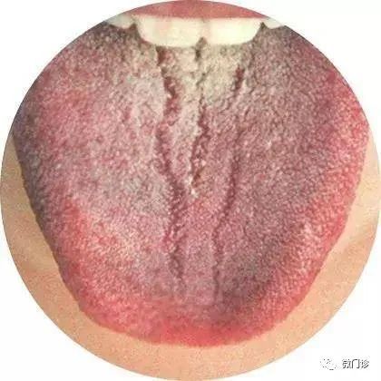 舌头总有裂纹，脾虚！一张方子，健脾养舌，令人深思