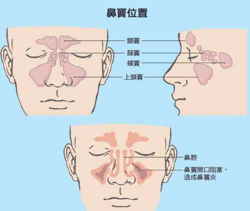 急性鼻窦炎,会引起鼻塞,眼睛和脸局部区域肿胀,引起面部疼痛或头痛