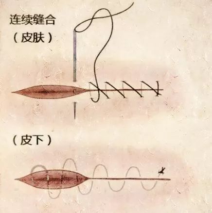 骨科手术缝合方法和缝合材料的选择