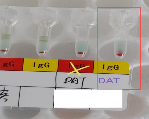 输血后11天出现浓茶色尿,是迟发性溶血反应还是另有隐情?