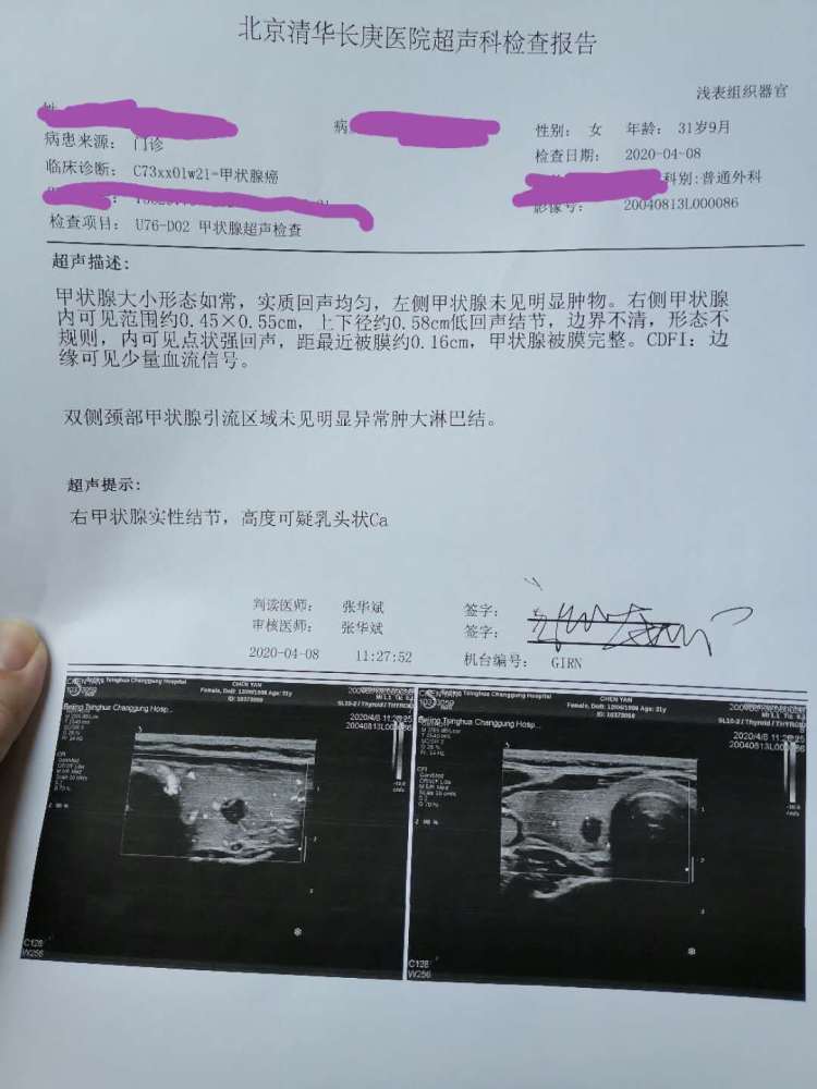 如何解读甲状腺结节超声报告及常见误区