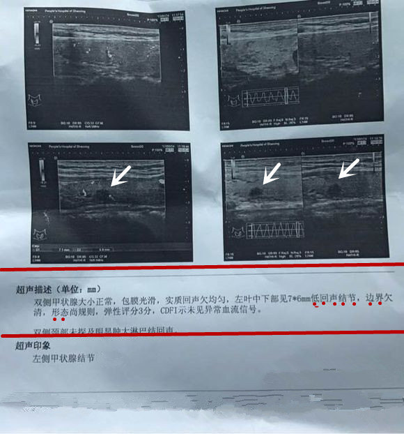 如何解读甲状腺结节超声报告及常见误区