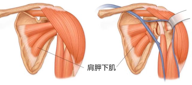 肩周炎久治不愈的"绝招"——不容忽视的肩胛下肌!
