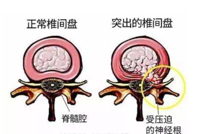 老铁，腰不行？常见腰疼鉴别处理方法！