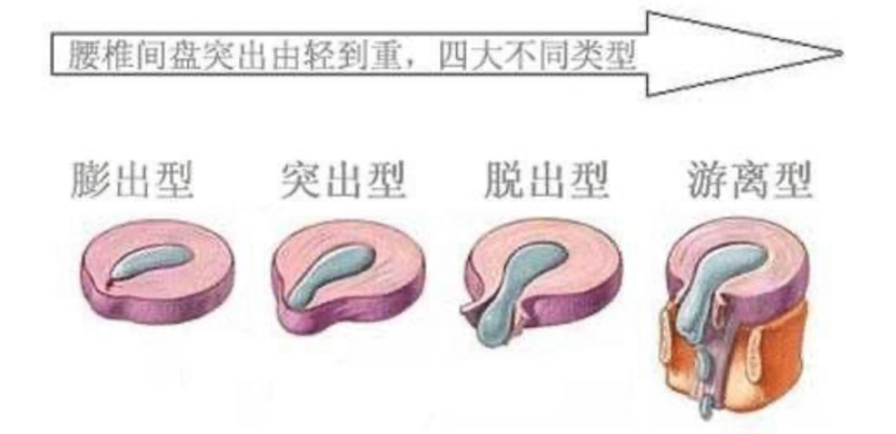 老铁，腰不行？常见腰疼鉴别处理方法！