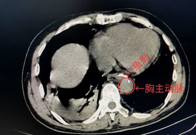 一男子吞下鱼刺险丢性命！三明医生凌晨紧急手术！