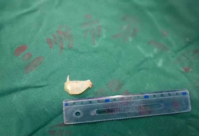 一男子吞下鱼刺险丢性命！三明医生凌晨紧急手术！