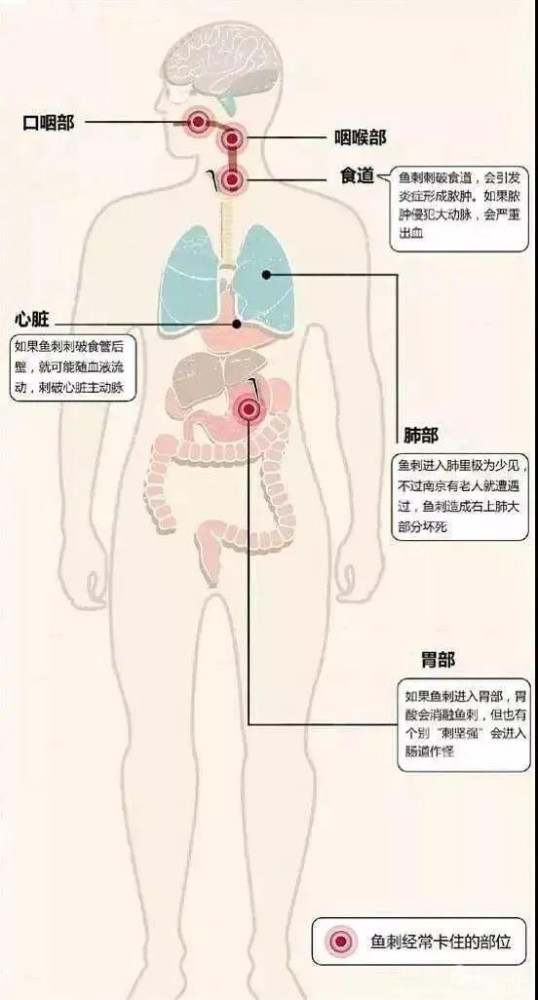 一男子吞下鱼刺险丢性命！三明医生凌晨紧急手术！
