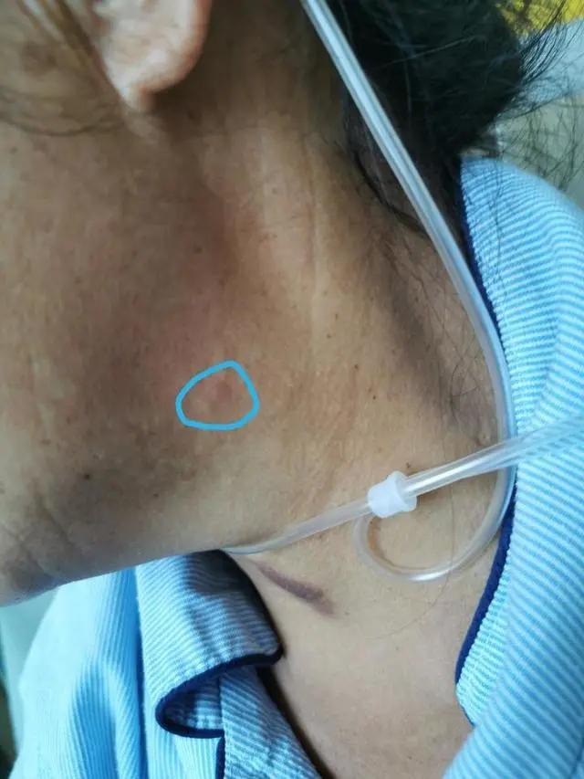 5天高烧40℃，女子新冠检测阴性，再查竟是感染这种病毒