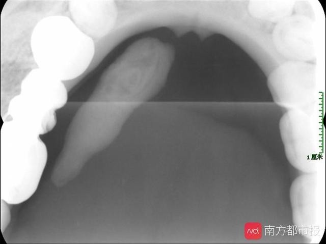 活久见广州男子口里掏出子弹头竟是口腔内腺体导管结石