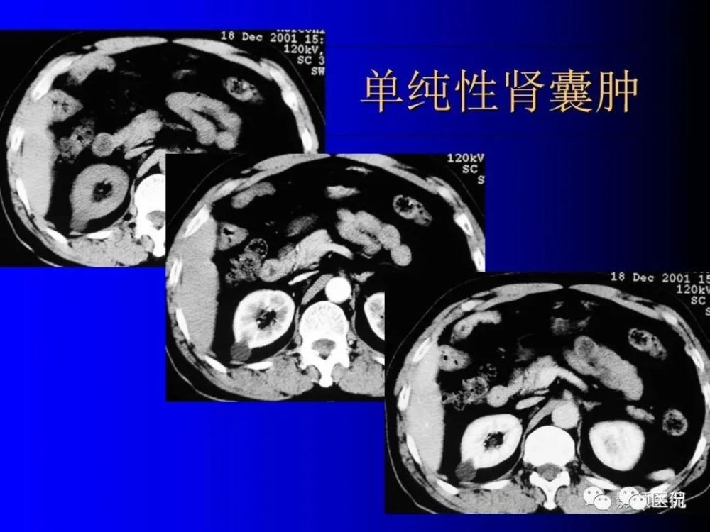 肾囊肿内含有血液,脓液,间隔或钙化 出血性囊肿. 感染性囊肿.