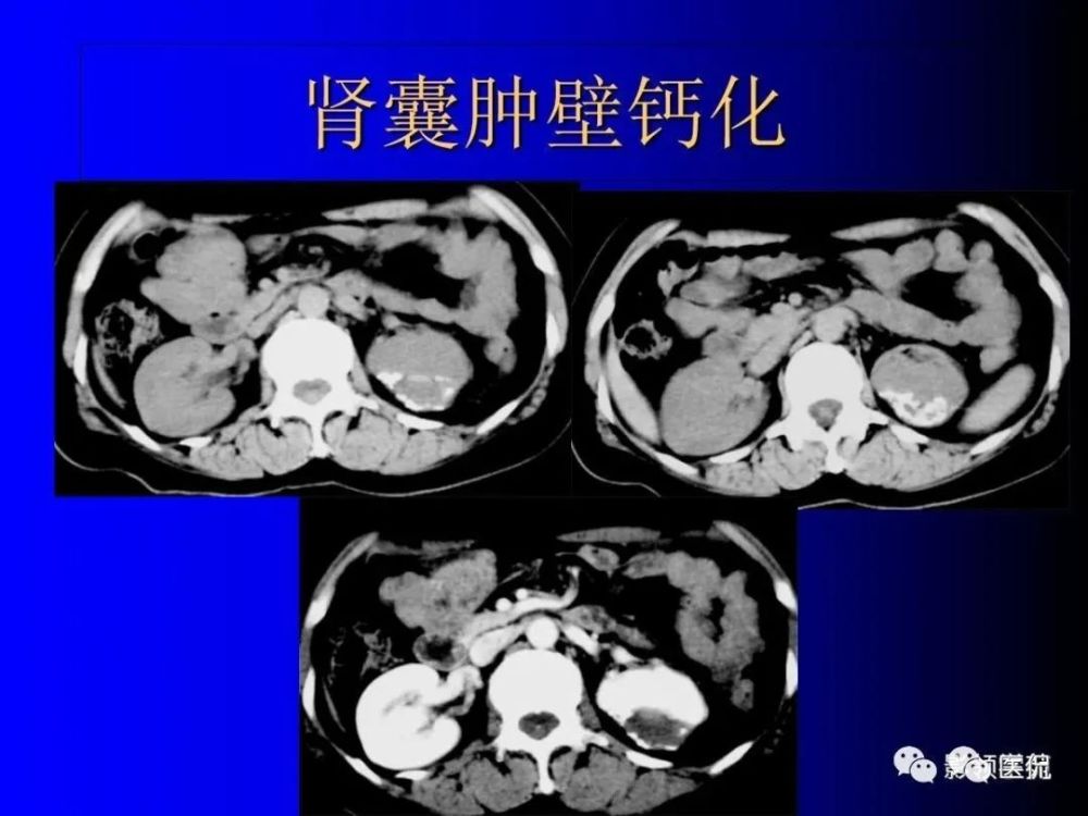 肾囊肿内含有血液,脓液,间隔或钙化2,复杂性肾囊肿(complicated cysts