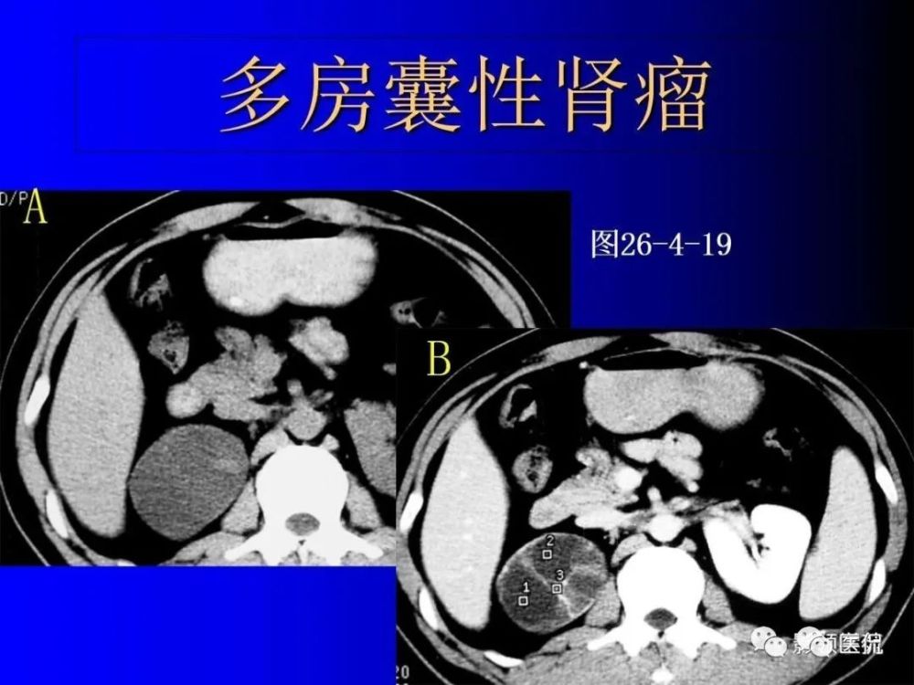 肾盂源性囊肿较大,偏中央. 肾盏憩室较小,偏周围.