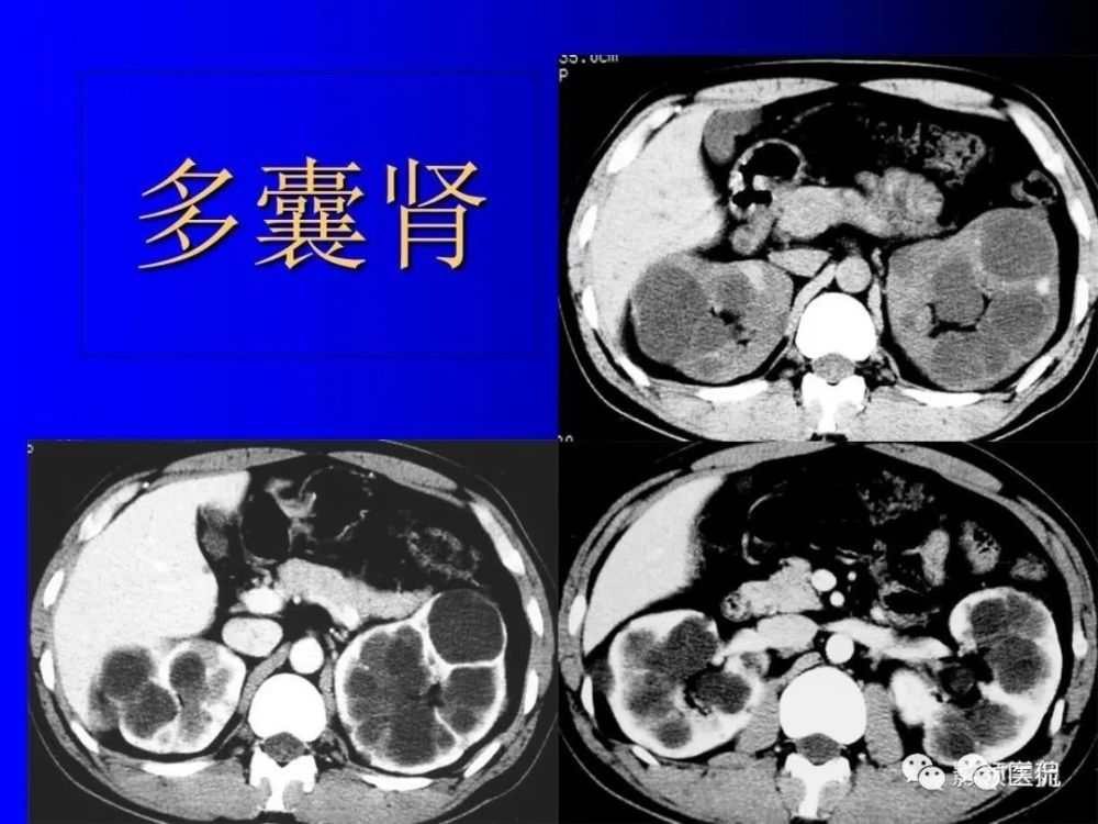 (隐性者多见于婴幼儿,偶见于青少年,此型常合并先天性肝纤维化,预后差