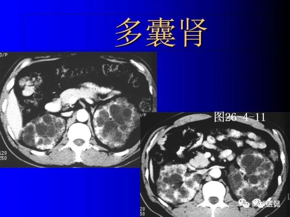 7,髓质海绵肾(medullary sponge kidney