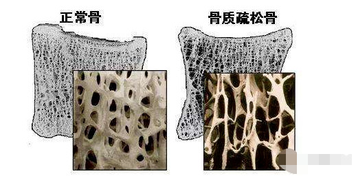 万茜骨折实锤！眼看就要成为顶流却瞬间凉凉！