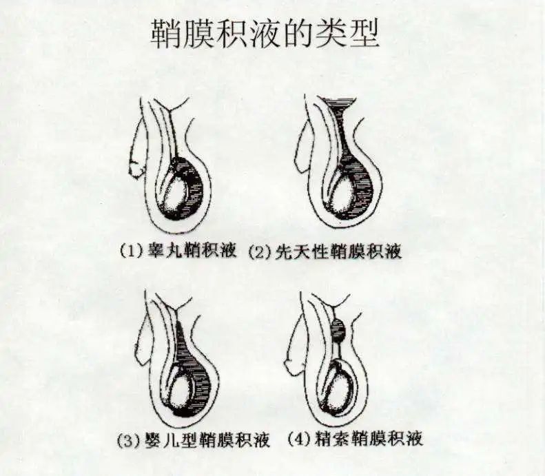 或者阴囊上方增大,好像多了一个睾丸