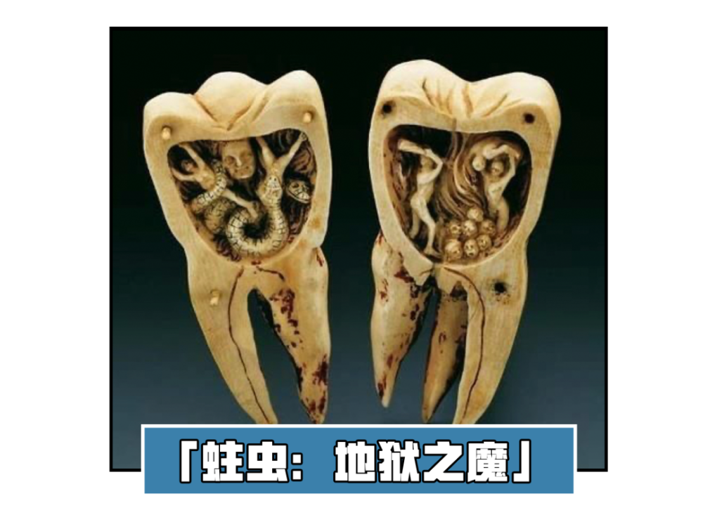 在现代医学确定细菌导致龋齿之前 人们一直以为蛀牙是小虫子施工