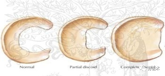 半月板解剖及损伤的详细图解