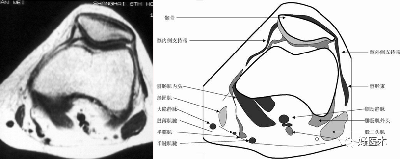 半月板解剖及损伤的影像诊断