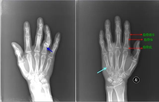 【影像诊断】右图:左侧第二指骨近节指骨骨折【影像诊断】左图:左侧第
