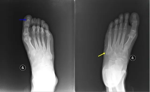 110张经典x线片影像诊断,夜班医生必备纯干货!
