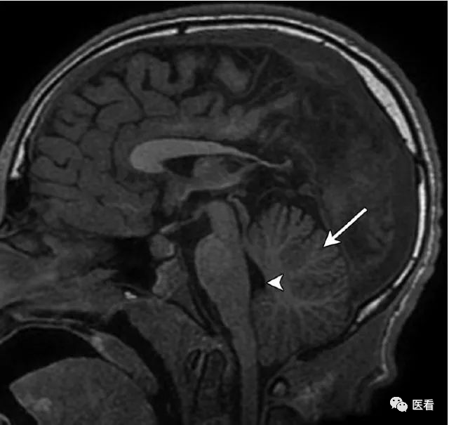 汇总收藏这23个病例搞定大脑中线处mri诊断