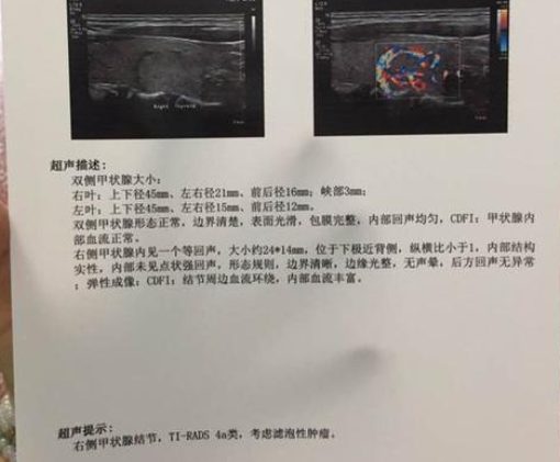 得了甲状腺结节,医生只让随访,不想手术?这样治疗结节