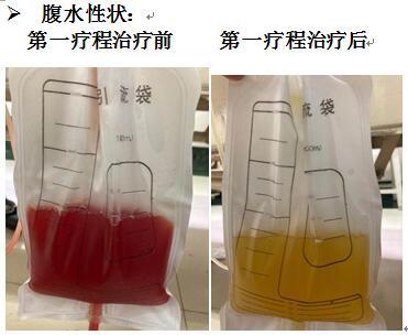 原研新技术山东大学齐鲁医院完成载药囊泡治疗恶性腹水首例临床治疗