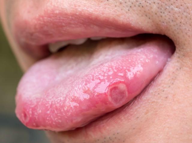 这些症状以为是溃疡提醒这或是舌癌的早期表现别忽视